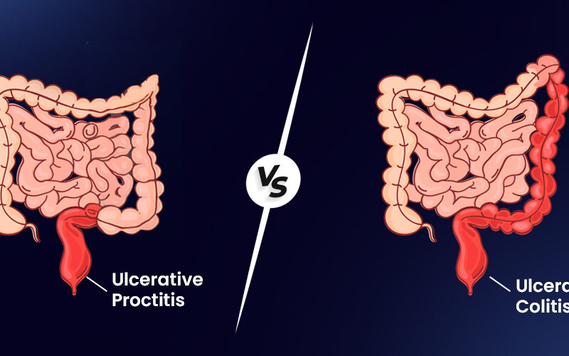 Ulcerative Proctitis vs Ulcerative Colitis