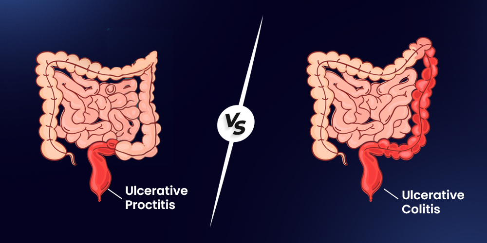 Ulcerative Proctitis vs Ulcerative Colitis