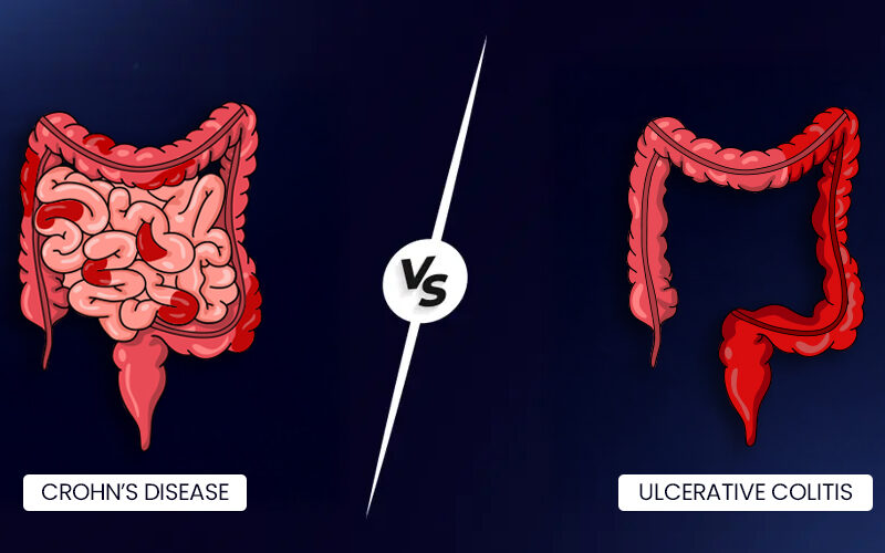 Crohn’s Disease vs Ulcerative Colitis