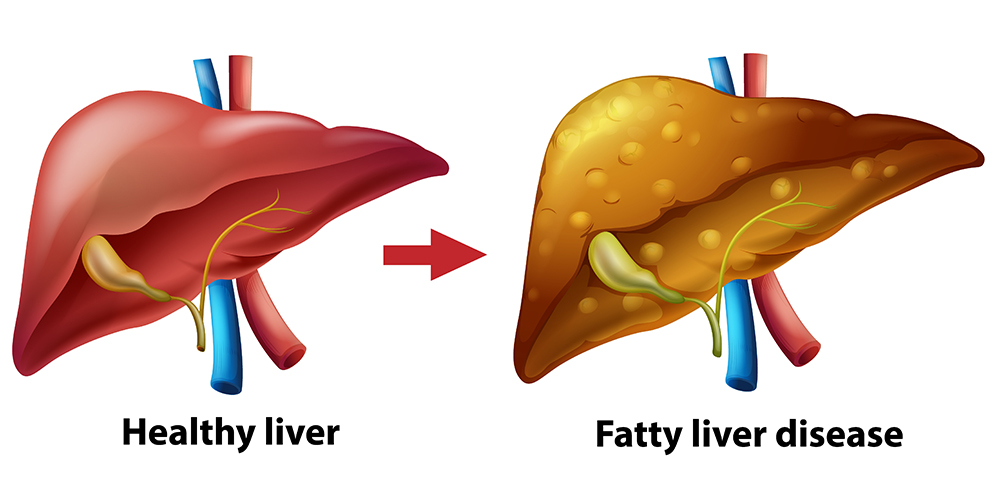Healthy Liver vs Fatty Liver Disease