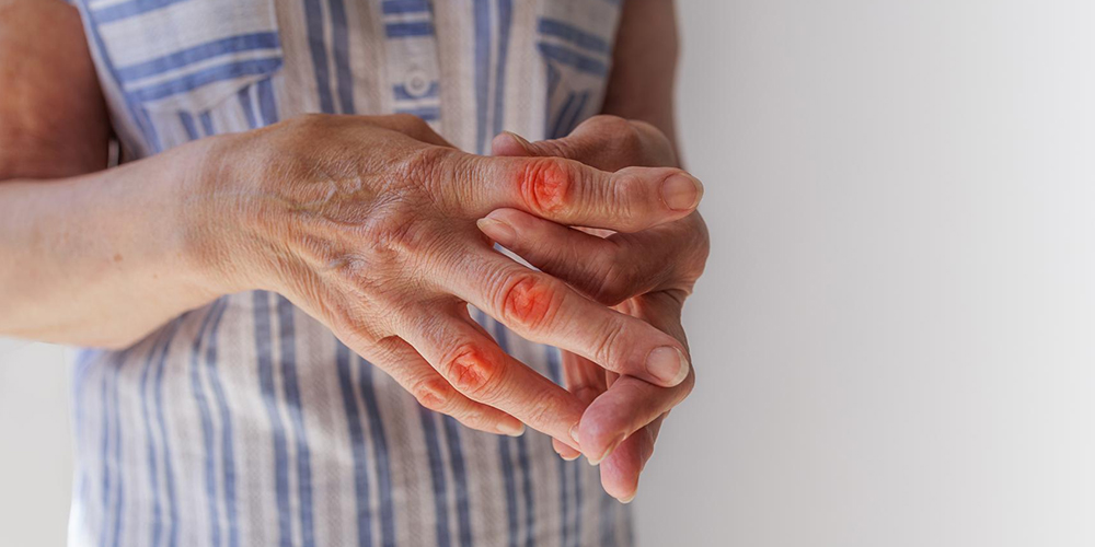 Seropositive Rheumatoid Arthritis