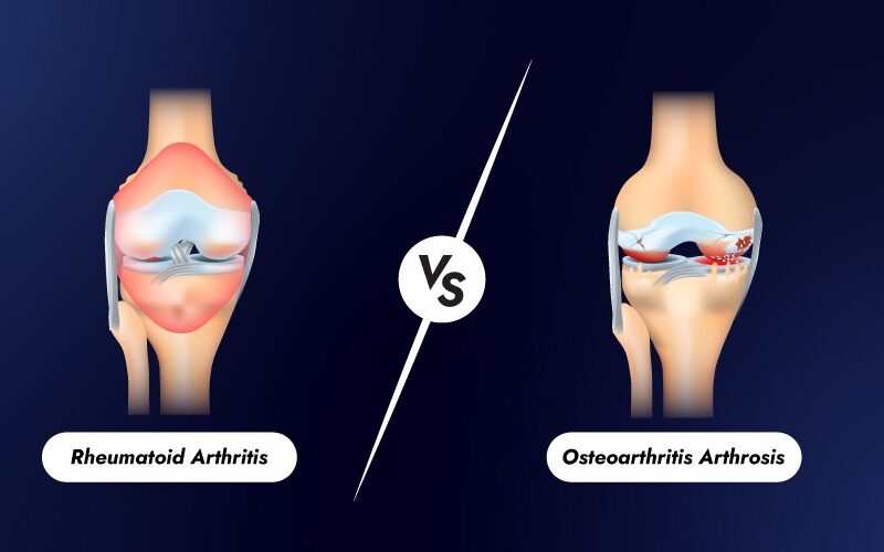 Osteoarthritis vs Rheumatoid Arthritis