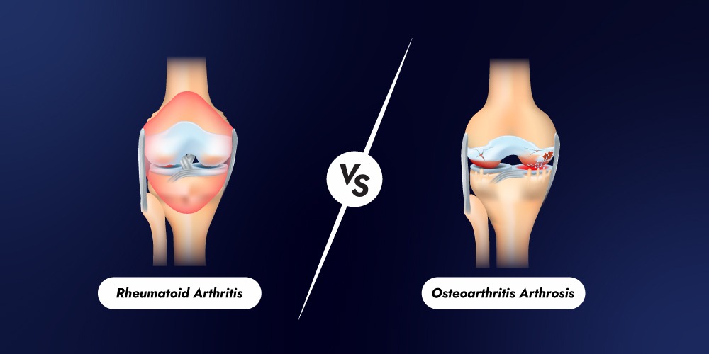 Osteoarthritis vs Rheumatoid Arthritis