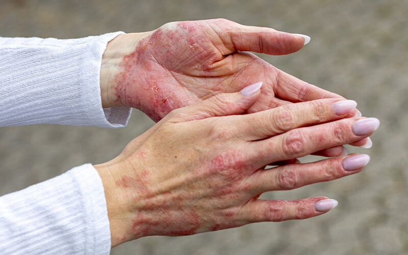 Psoriatic Arthritis