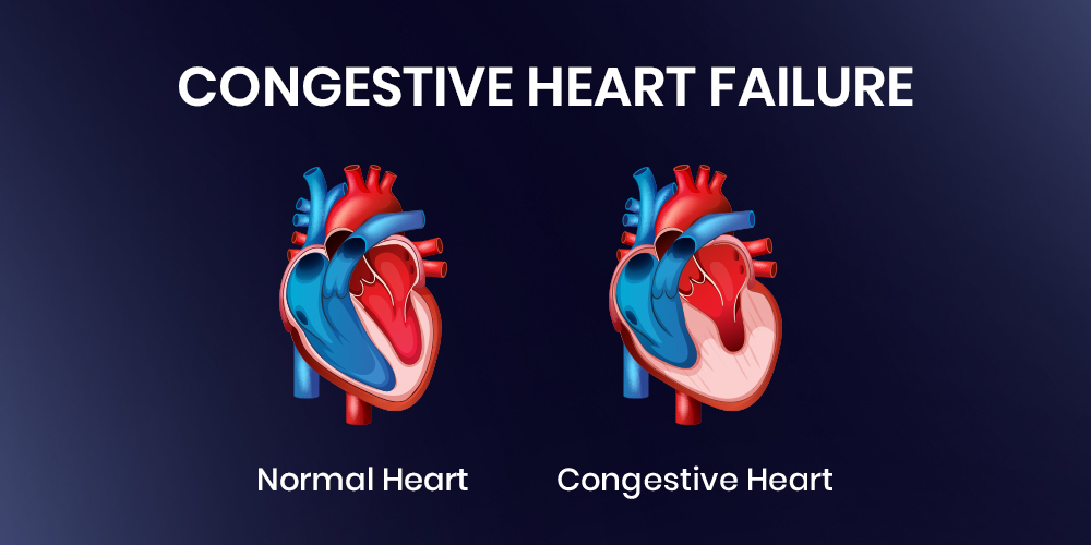 Know About Congestive Heart Failure